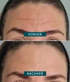Силиконовый патч для лба Apricot Reusable Forehead Pad, с витамином C, многоразовый, 1 шт — фото 3