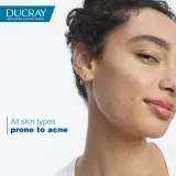 Ducray Keracnyl Foaming gel - Пенящийся гель для умывания жирной кожи с проблемами акне — фото 8
