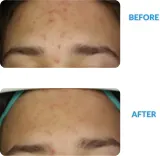 Dermedic Redness Calm - Крем против покраснений и расширенных сосудов, 40 мл — фото 6