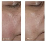Perricone MD No:Rinse Pore Minimizing Toner - Интенсивный тоник для сужения пор и смягчения кожи, 118 мл — фото 4