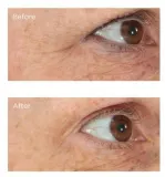 Perricone MD Essential Fx Acyl-Glutathione Eyelid Lift Serum - Сыворотка для лифтинга вокруг глаз, 15 мл — фото 2