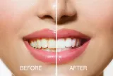 Набор RIO USB teeth whitening для отбеливания зубов, с лампой LED — фото 6