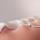 Насадки для ирригатора Philips Sonicare HX3072/00 для межзубных промежутков, 2 шт — фото 8