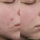 Крем для зрелой кожи лица, проблемная кожа BYOMA Blemish Clearing Cleanser, 175 мл — фото 2