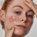 Сыворотка для лица The Inkey List Anti-Redness Solution with Azelaic Acid 10%, 30 мл — фото 3