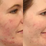 Очищающая пенка для лица Murad Clarifying Cleanser, 200 мл — фото 2
