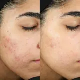 Murad InvisiScar Resurfacing Treatment средство для лица от следов постакне 15 мл — фото 4